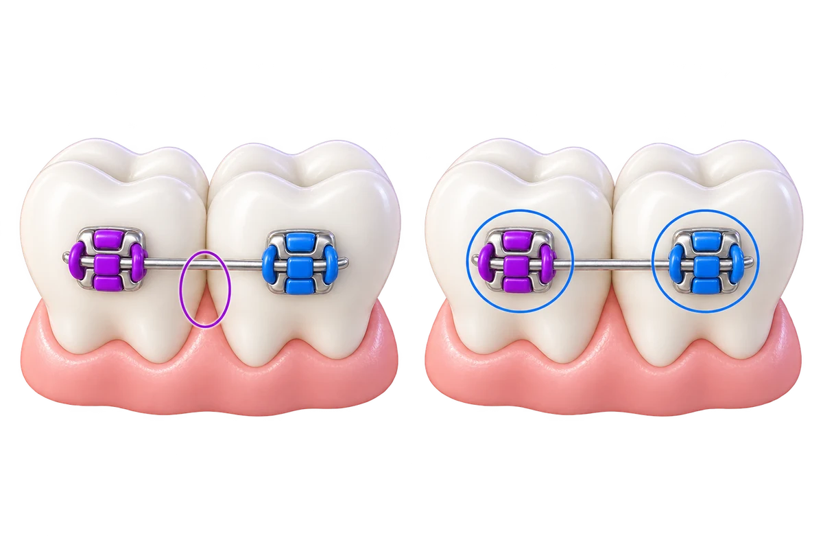 Deux dents portant des bagues, avec un cercle violet autour de l’espace entre les dents.