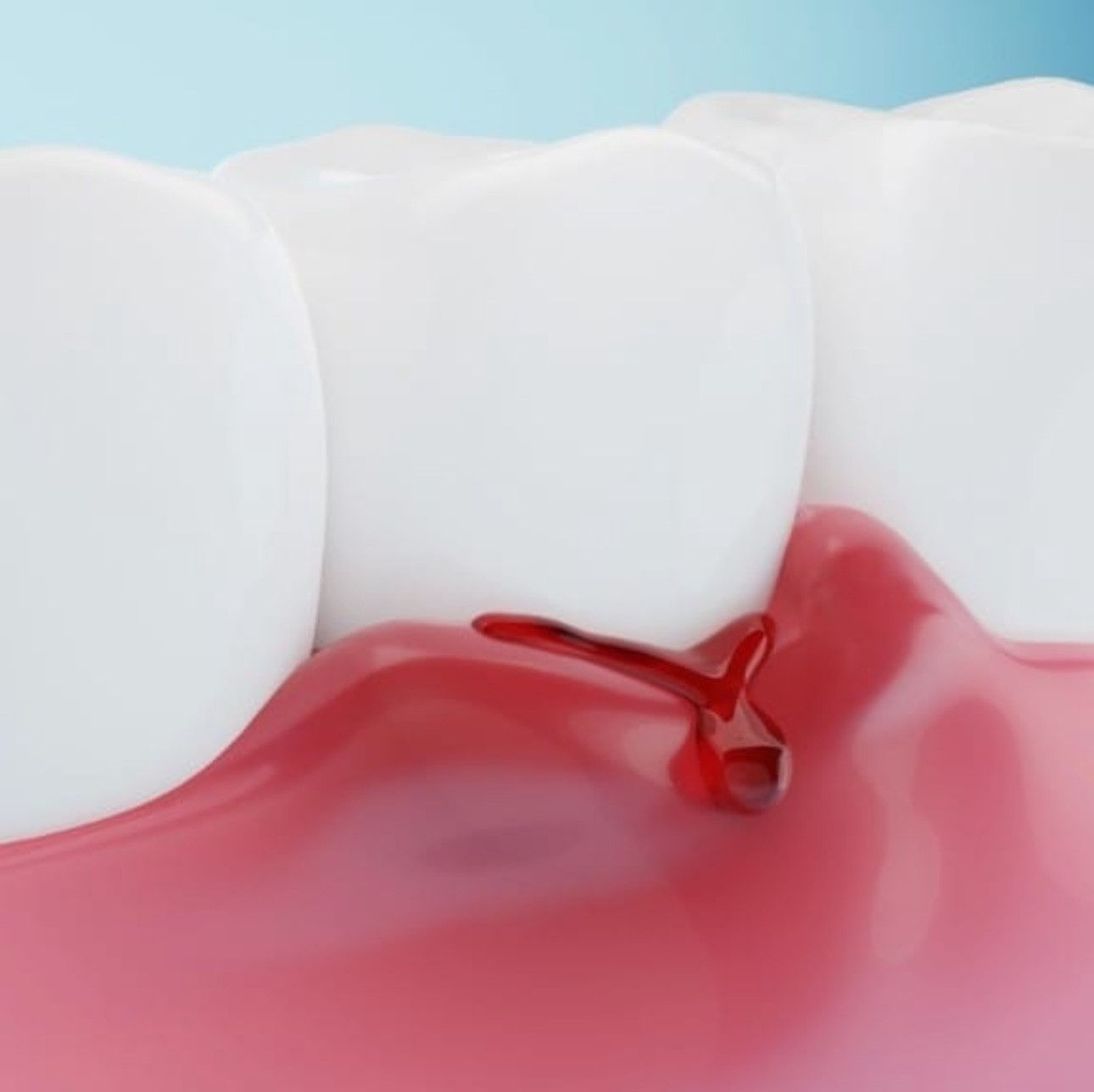 Fini caries gingivite